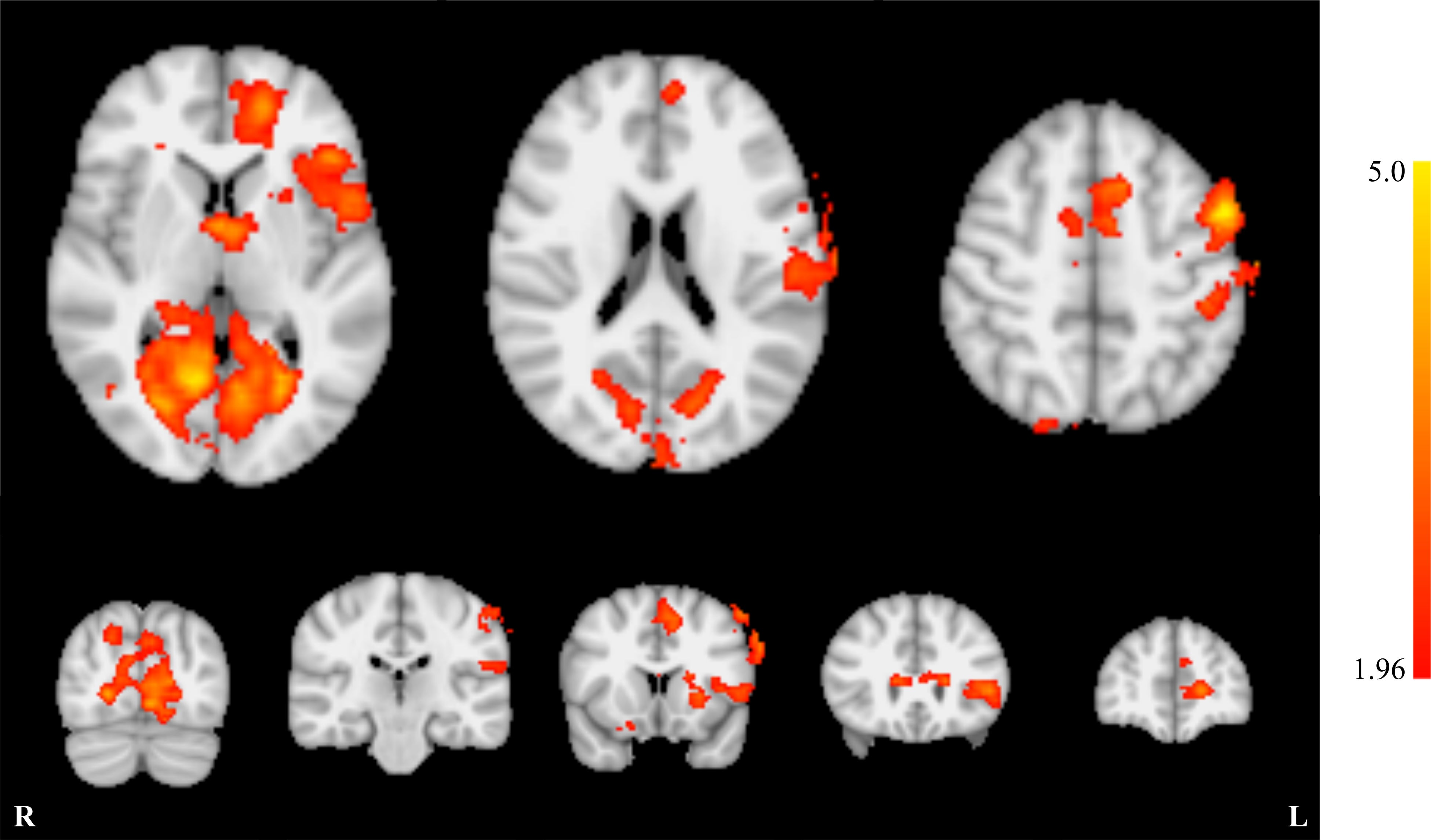 RSNA 2017: fMRI and neurofeedback: A potential promising treatment for tinnitus
