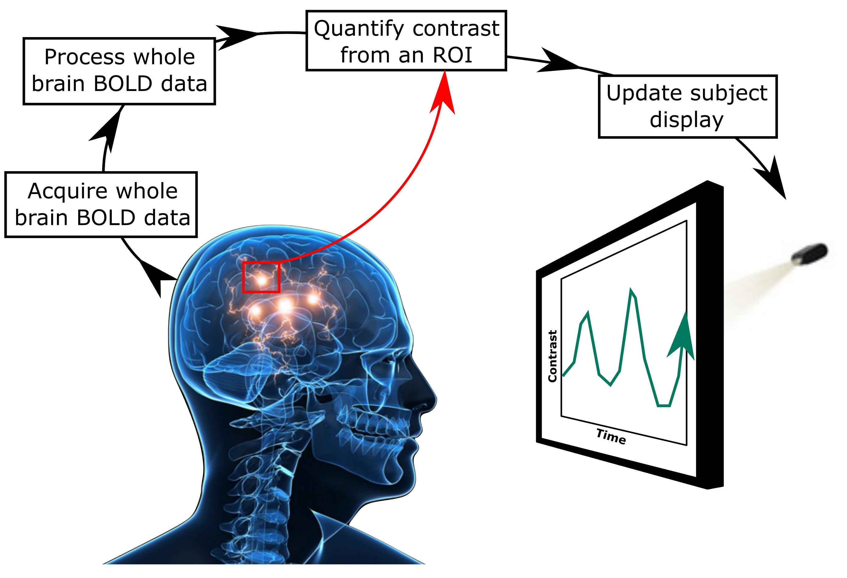 RSNA 2017: fMRI and neurofeedback: A potential promising treatment for tinnitus