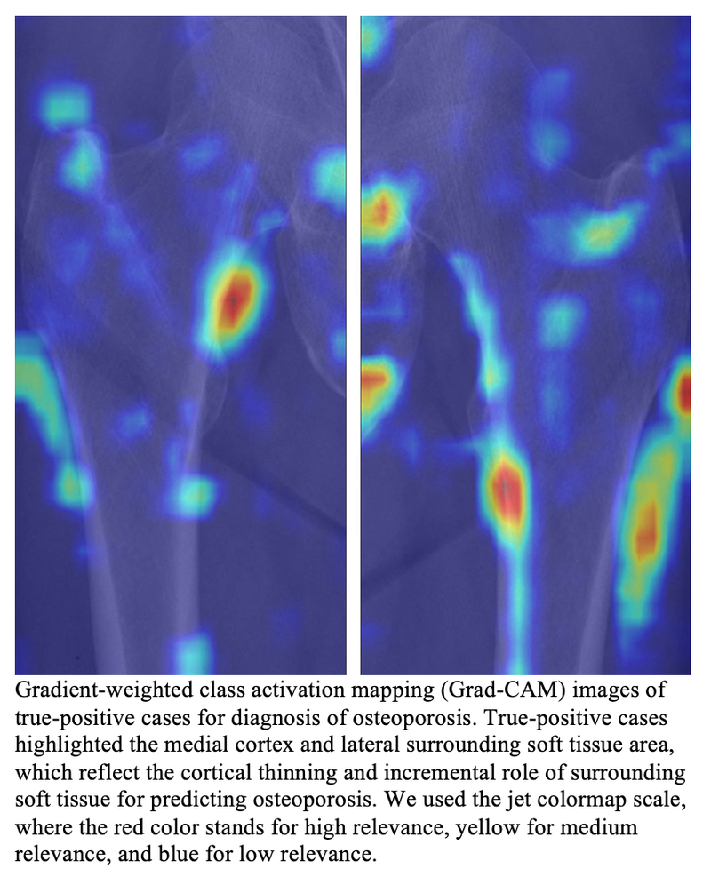 AI Model Detects Osteoporosis on Hip X-ray
