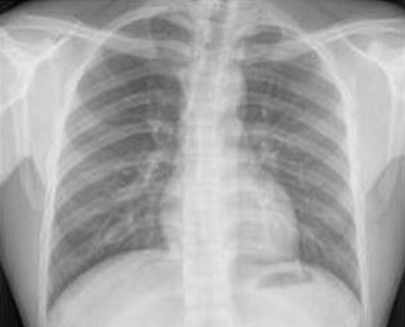 AI Used With Chest X-ray to Triage Chest Pain Patients