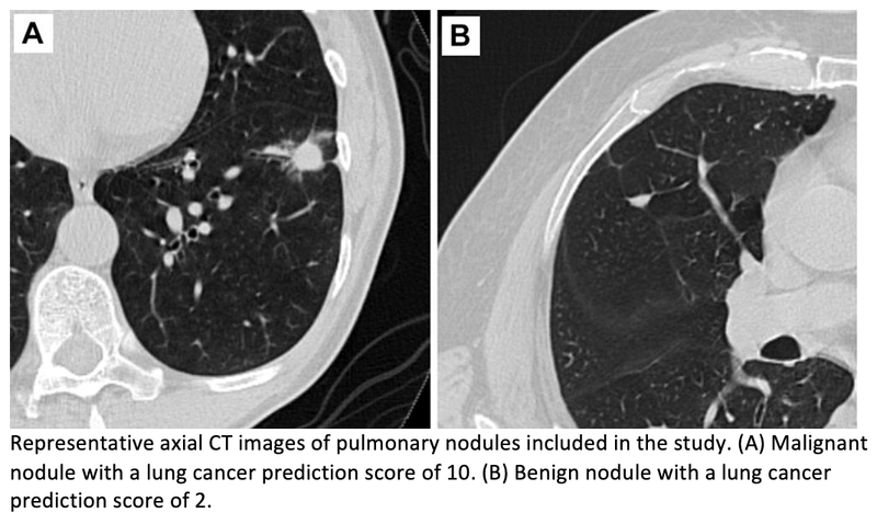 CT with AI Tool Helps Doctors Predict Cancer Risk in Lung Nodules