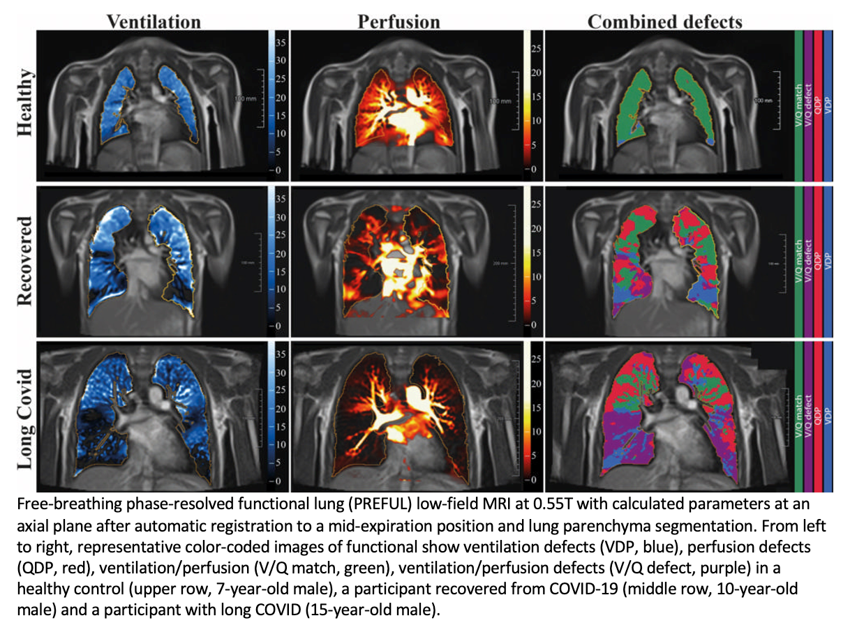 MRI Shows Persistent Lung Damage Due to COVID-19 in Children and Teens