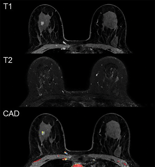 Prediction Models Could Reduce False Positives in Breast MRI Screening Exams