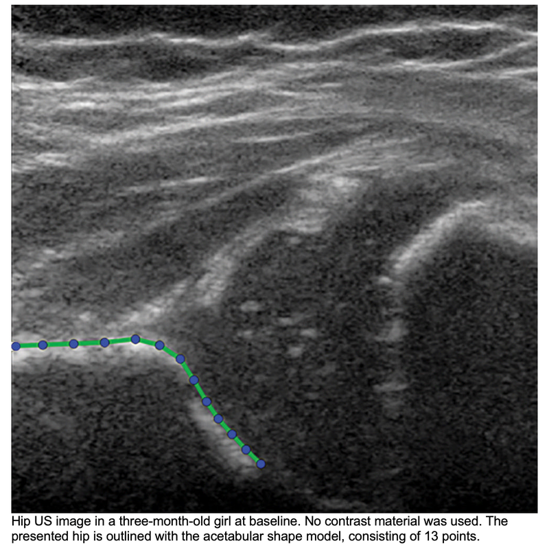Ultrasound Technique can Predict Which Infants With Hip Dysplasia Need Treatment