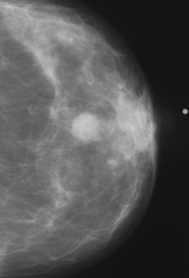 AI-Enabled Breast Screening Software Gets FDA Nod