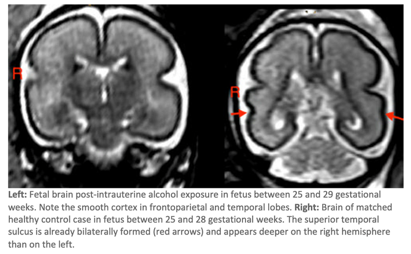 Fetal Brain Structure Changes When Mom Drinks During Pregnancy