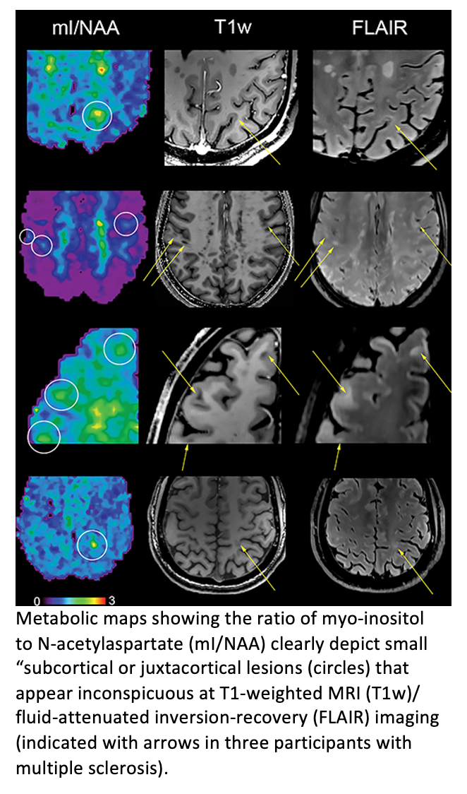 Proton MR Spectroscopy Detects Brain Changes in MS Patients Earlier