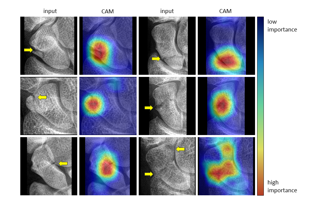 AI Detects Common Wrist Fracture on X-ray