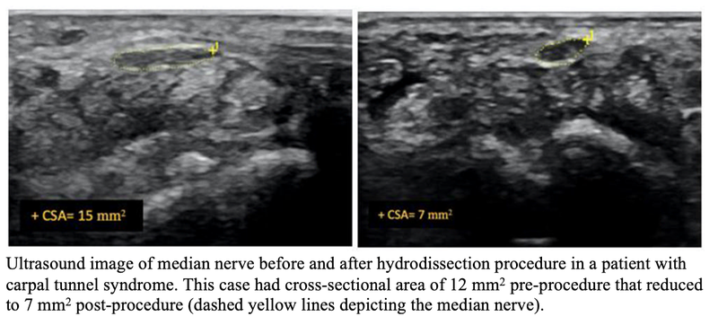 Minimally-Invasive Treatment Relieves Carpal Tunnel Syndrome