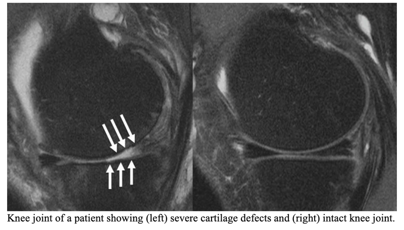 Common Steroid Injections Make Knee Arthritis Worse