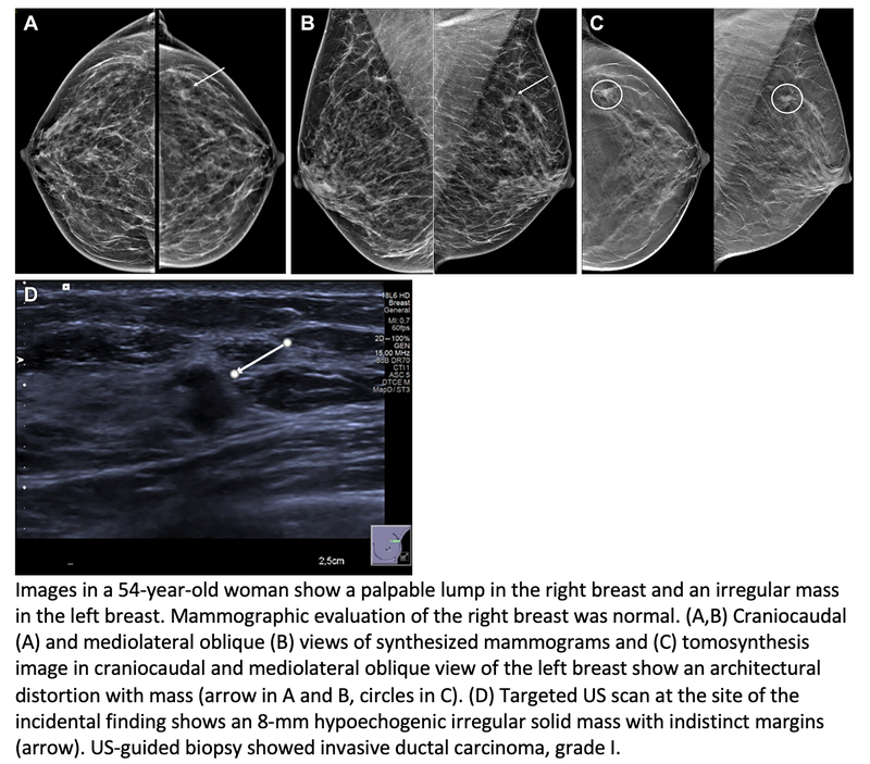 Ultrasound Effective as a Standalone Diagnostic Tool for Focal Breast Complaints