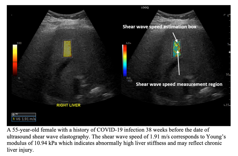 Liver Injury in COVID-19 Patients Detected Months After Infection Using Ultrasound