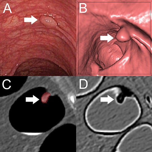 Radiomics-based Machine Learning Method Differentiates Colon Polyps
