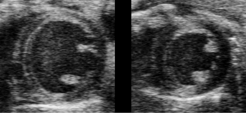Low-Dose Radiation Therapy Shows Potential to Treat Heart Failure