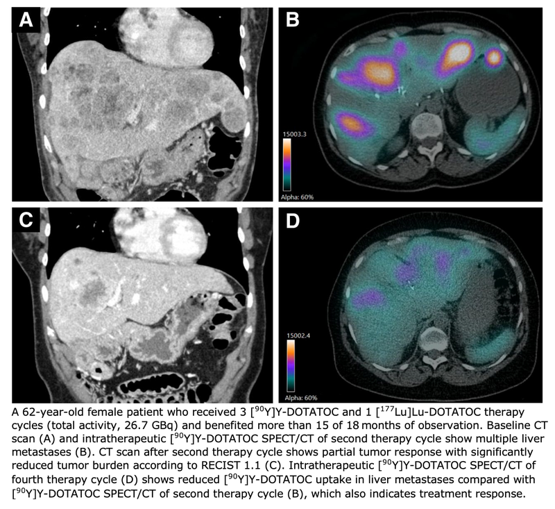 Radiopharmaceutical Therapy in Metastatic Insulinomas Controls Symptoms, Reduces Medications