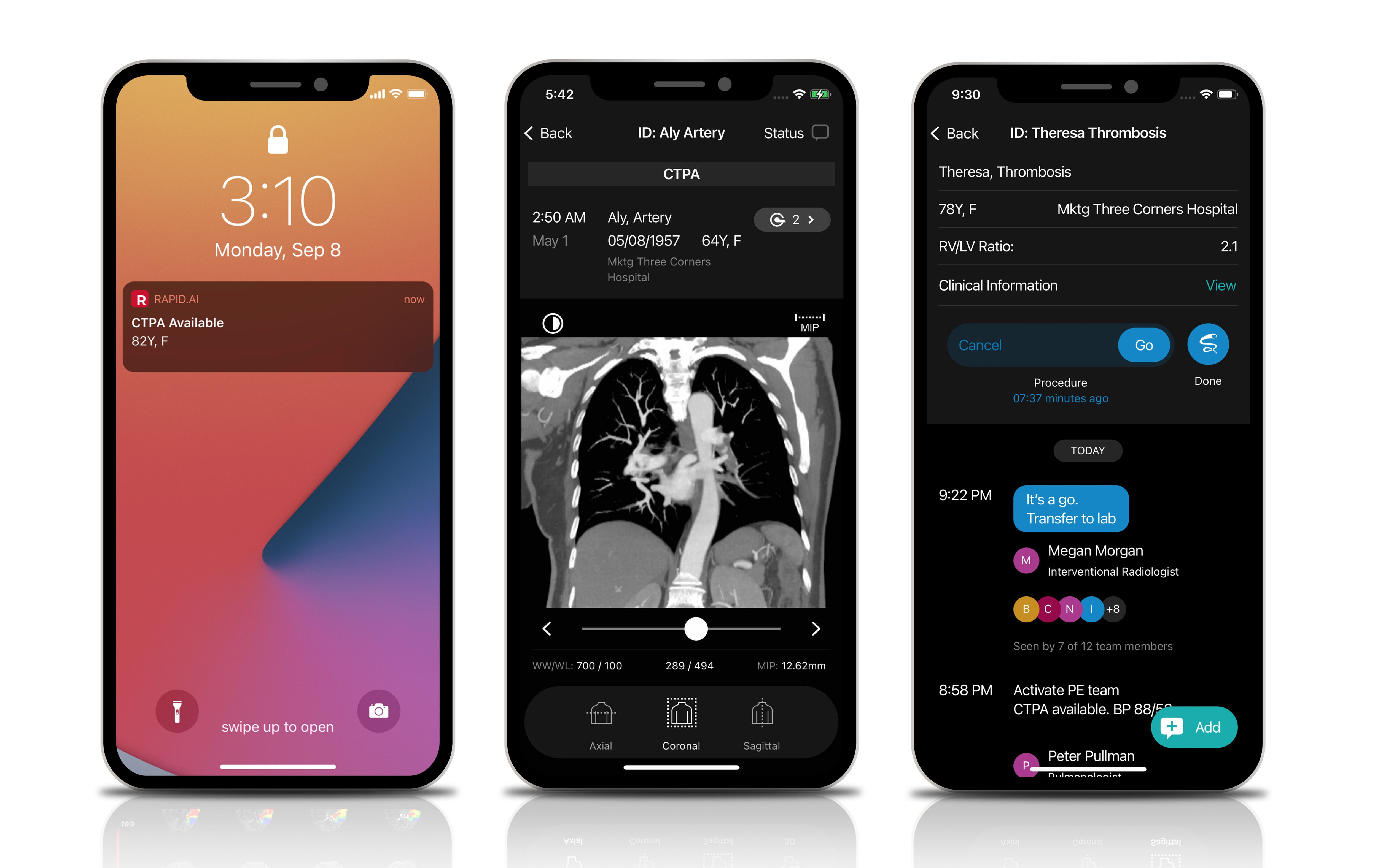 RapidAI Releases Workflow App for Treatment of Patients with Suspected Pulmonary Embolism