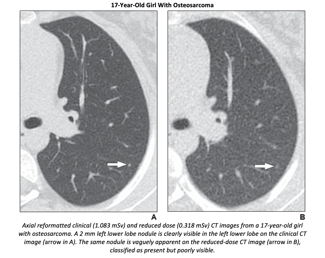 Reduced-dose CT Detects Most Lung Nodules Found on Standard-dose CT