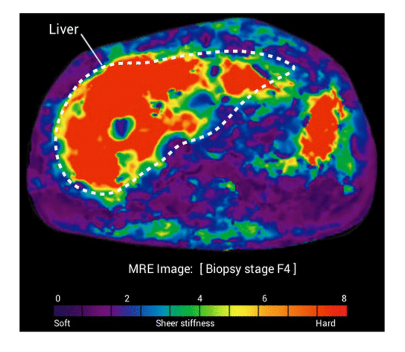 Canon Launches Open Bore 1.5T MRI, Partners with Resoundant for MR Elastrography