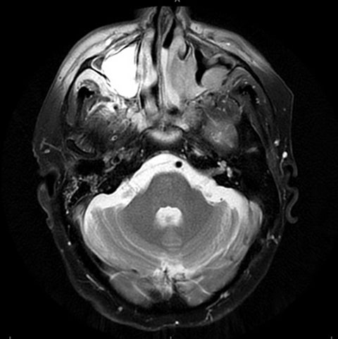 Case Report: Metastases from glioblastoma multiforme disguised as a new primary malignancy