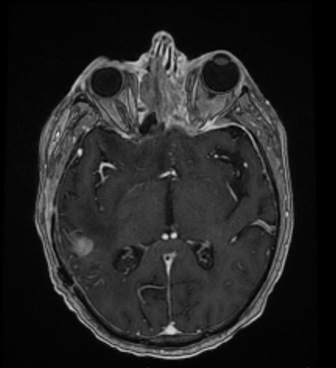 Case Report: Metastases from glioblastoma multiforme disguised as a new primary malignancy