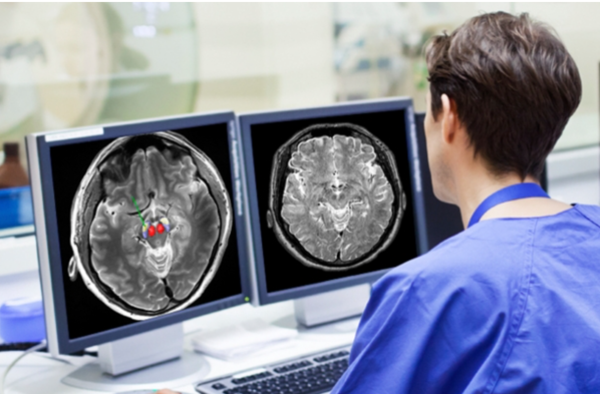 Updated Algorithm Provides New Visualization Capabilities for Deep Brain Stimulation Surgery