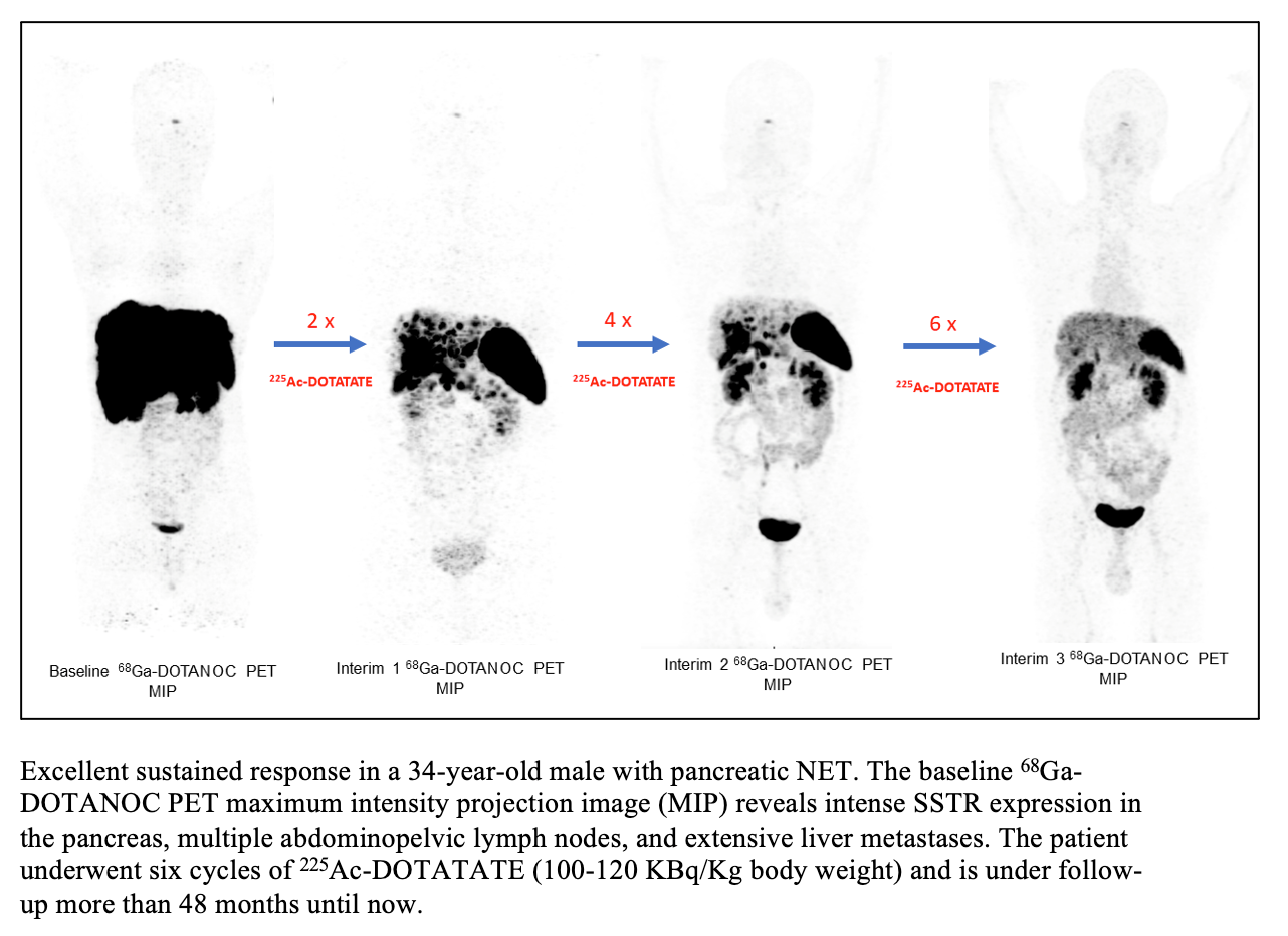 SNMMI 2022 Abstract of the Year: Radionuclide Treatment for Advanced-Stage Neuroendocrine Tumors