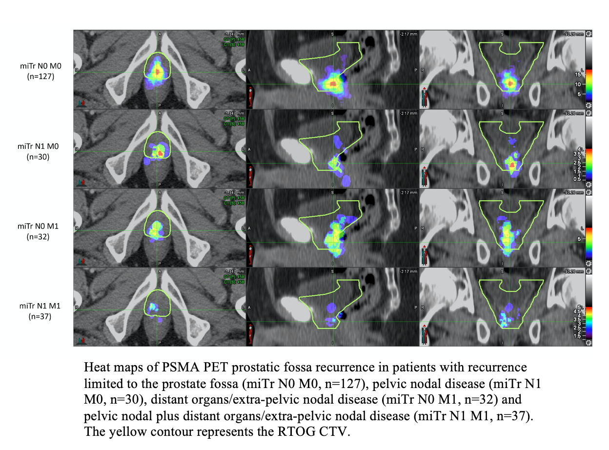 Prostate Cancer Therapy Guidelines Need Updating