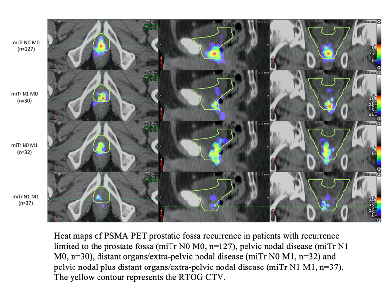 Prostate Cancer Therapy Guidelines Need Updating