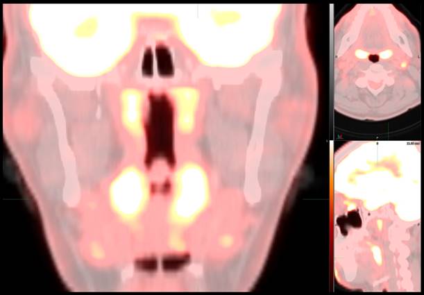 Unusual Imaging Finding in FDG-PET may be Omicron Infection