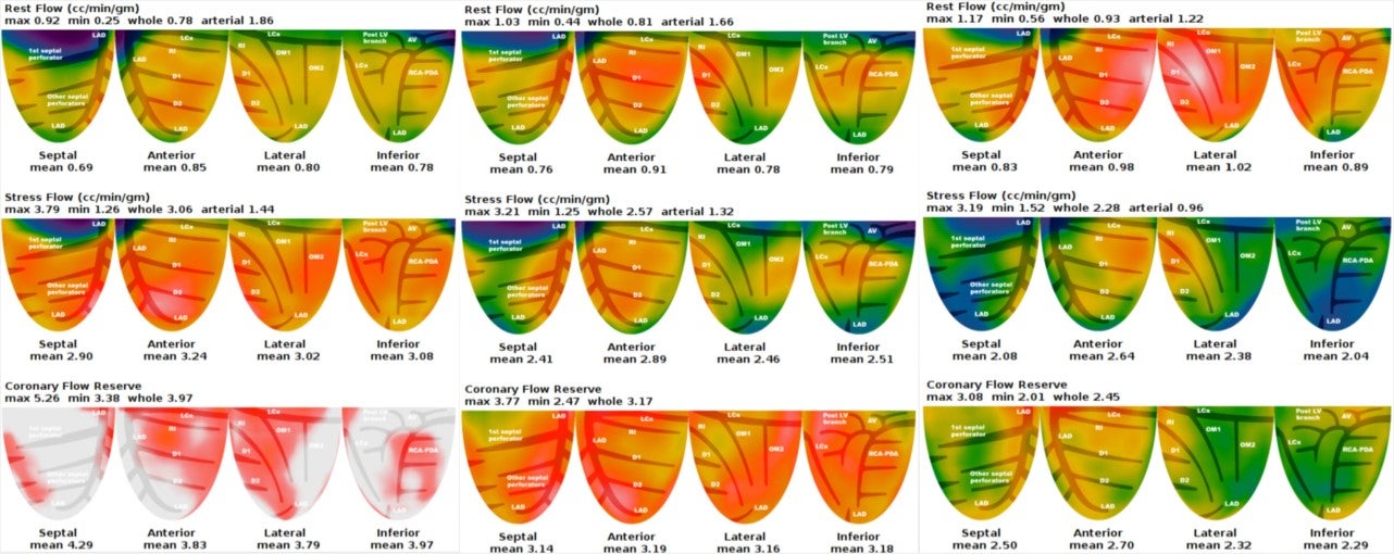 SNMMI 2019: Using PET/CT to detect cardiovascular disease risk factors in sleep apnea patients