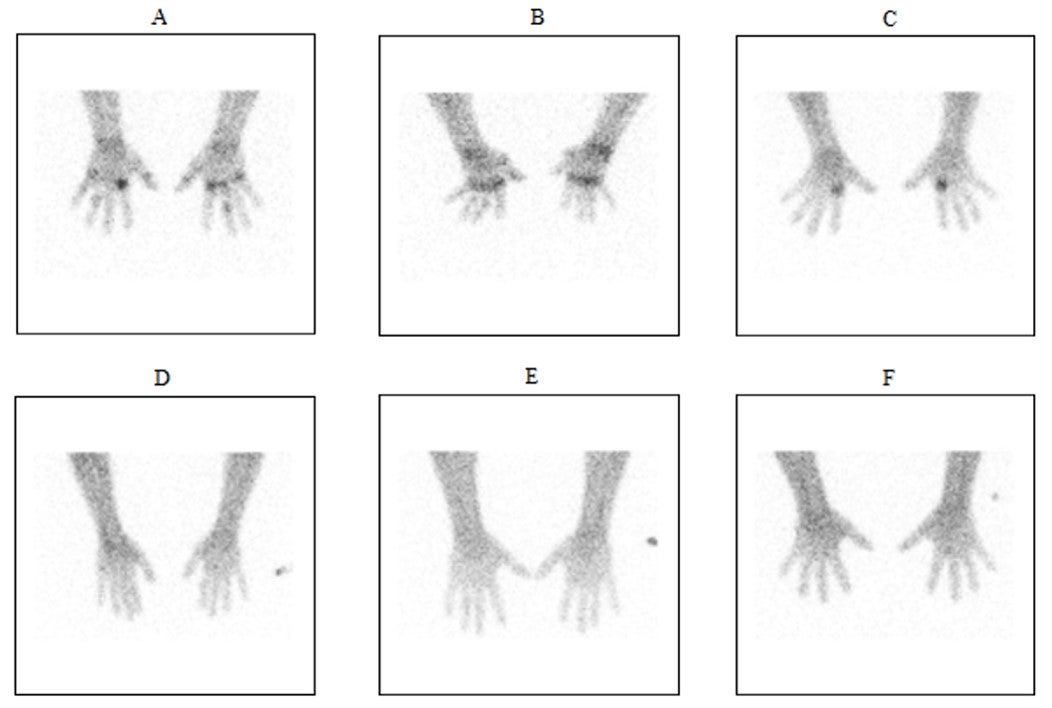 SNMMI 2019: Radiopharmaceutical monitors rheumatoid arthritis progression