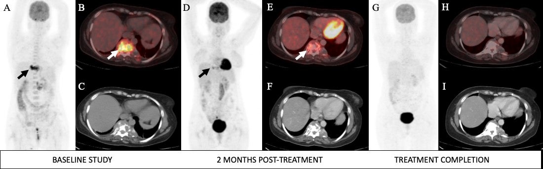 SNMMI 2019: PET/CT beneficial exam for diagnosing extra-pulmonary tuberculosis