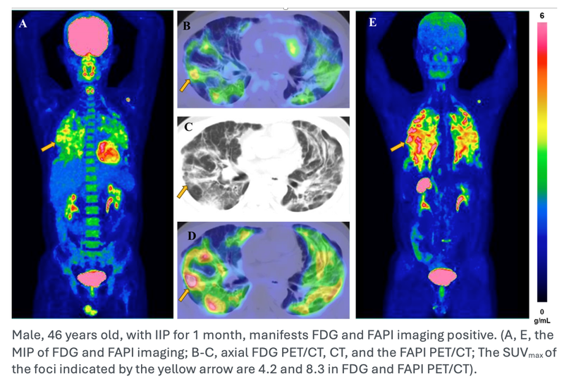 FAPI PET/CT Better Than FDG in Predicting Progressive Lung Disease