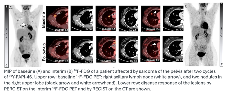 FAP-Targeted Therapy Shows Significant Efficacy Controlling Advanced Sarcomas