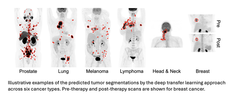 AI Tool Accurately Detects Six Different Cancer Types Using Whole-Body PET/CT