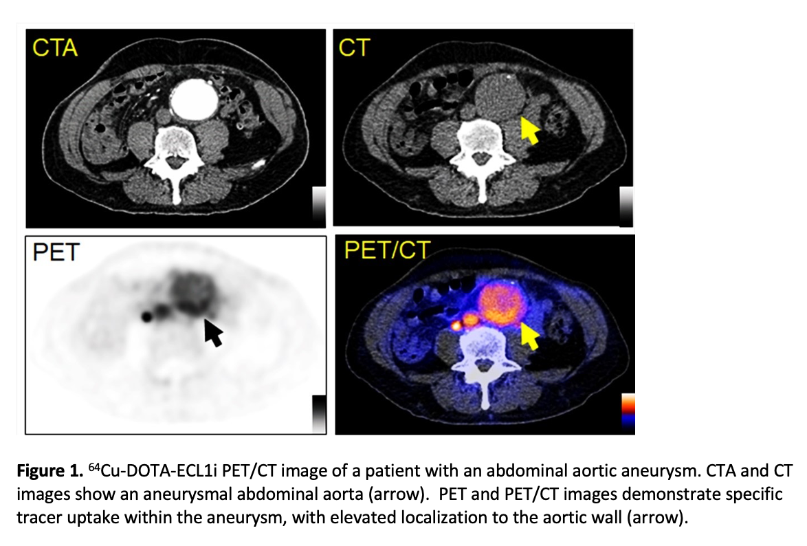 SNMMI ’21: Novel Radiotracer Could Predict Abdominal Aortic Aneurysm Rupture