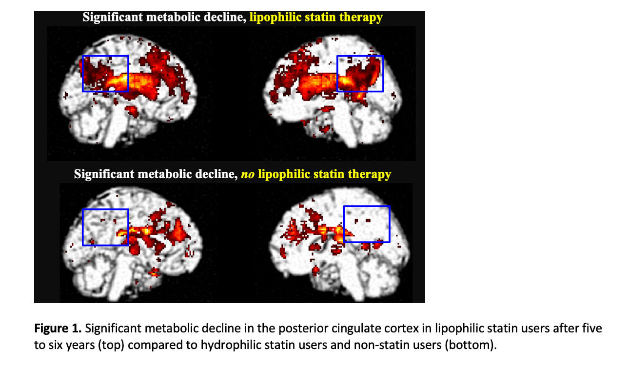 SNMMI ’21: Lipophilic Statin Use Linked to Increased Risk of Dementia