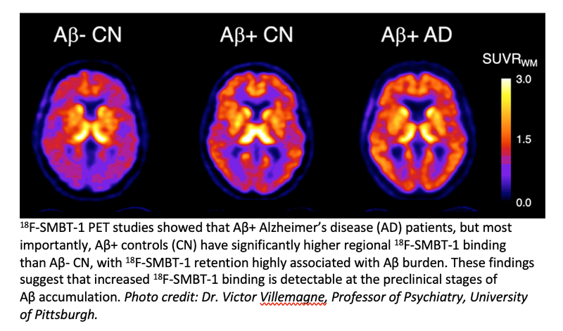 PET Radiotracer Detects Early Signs of Alzheimer Disease