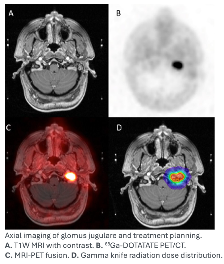 PET/CT Superior to MRI for Lesion Detection in Head and Neck Paragangliomas