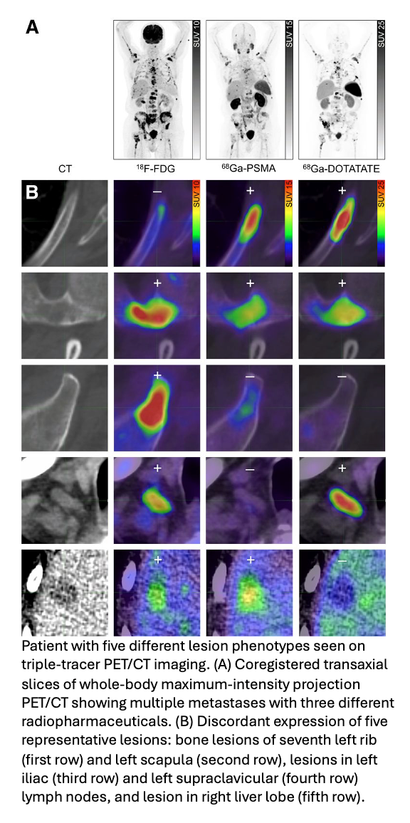 Multi-Tracer PET Personalizes Advanced Prostate Cancer Management
