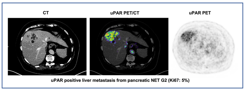New PET Tracer Detects Biomarker Tied to Aggressive Neuroendocrine Neoplasms