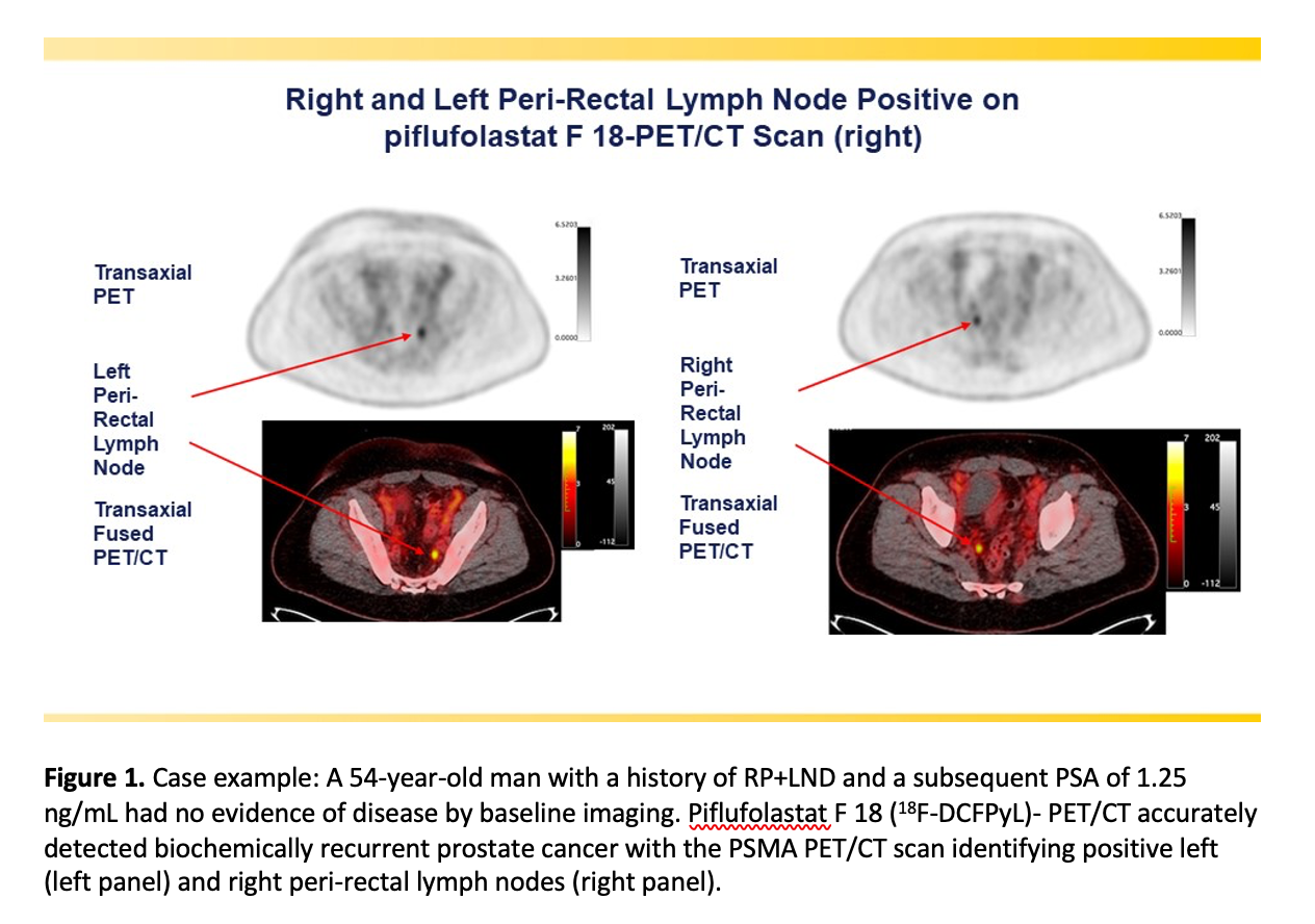 SNMMI ’21: PSMA-Targeted Radiotracer Pinpoints Metastatic Prostate Cancer