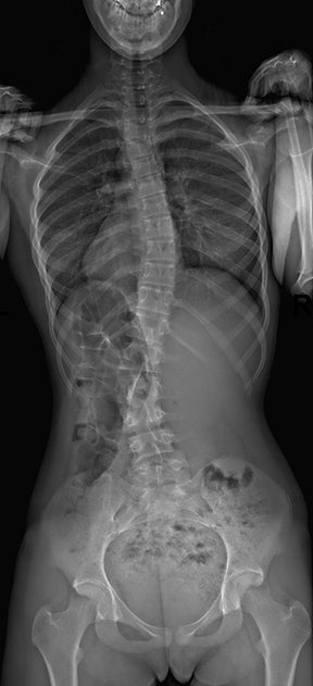 Improving safety of x-ray exams using slot-scanning x-ray systems