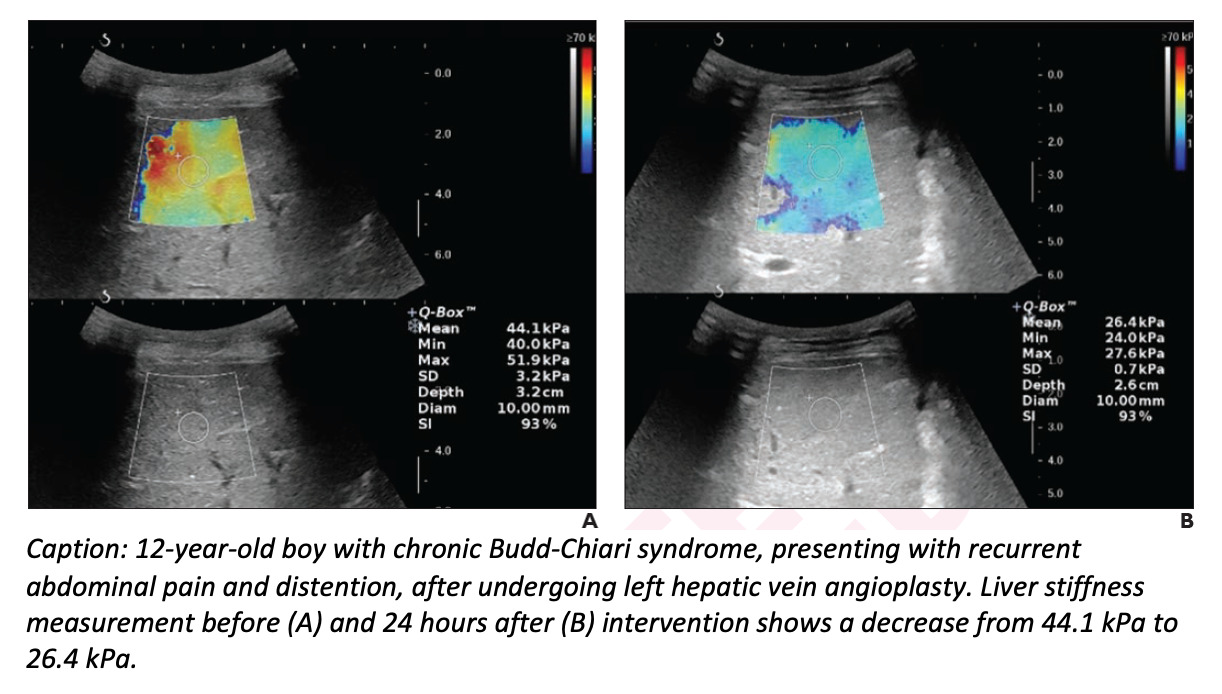 SWE Helps Monitor Pediatric Budd-Chiari Syndrome