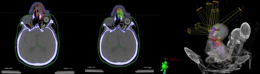 Radiotherapy Treatment in Nasal Diffuse Large B-Cell Lymphoma: A Case Report