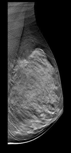 FDA clears first standalone 3D-only screening mammography system