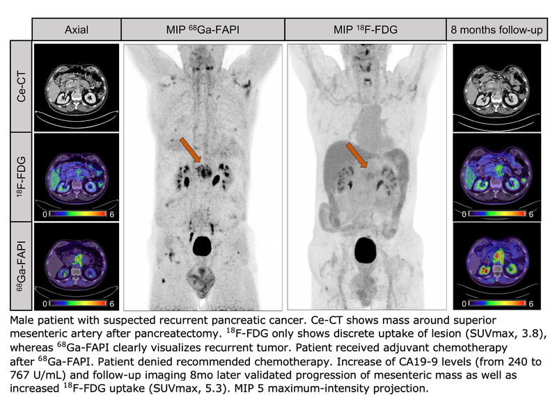 Ga-68 PET Improves Detection, Staging of Pancreatic Cancer