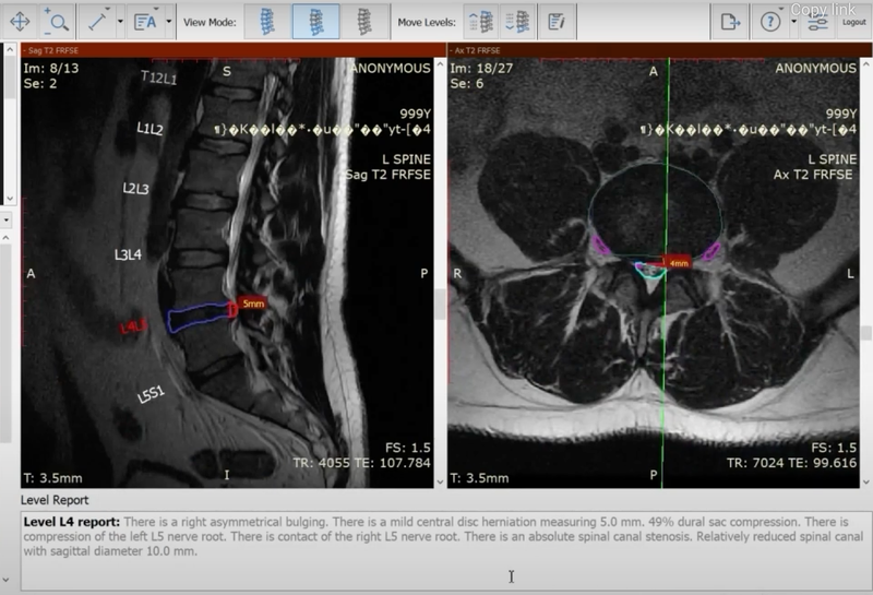 Lumbar Spine AI Software for MRI Receives FDA Clearance