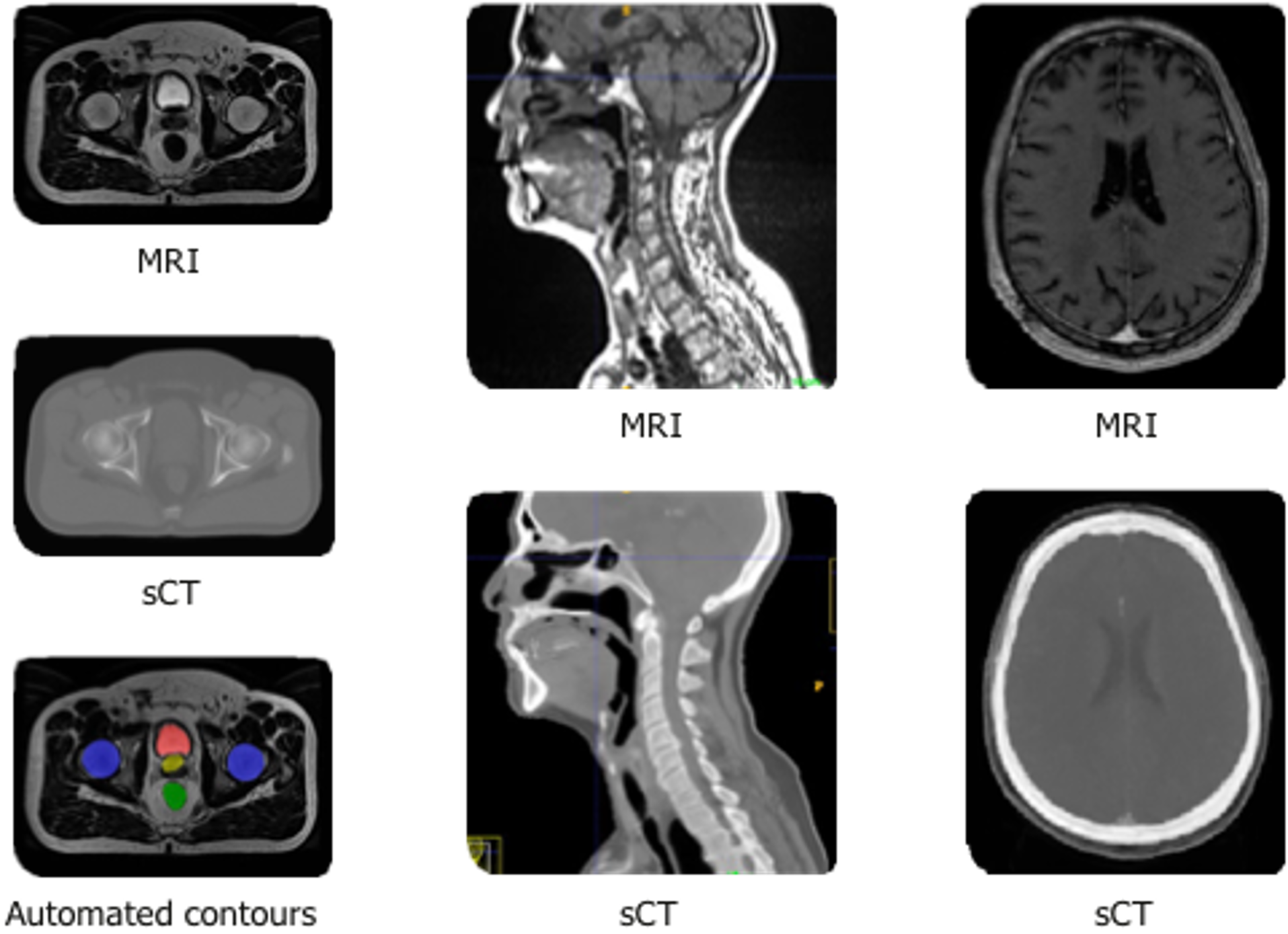 GE to Integrate Spectronic AI-based Software for MR-only Radiotherapy Planning