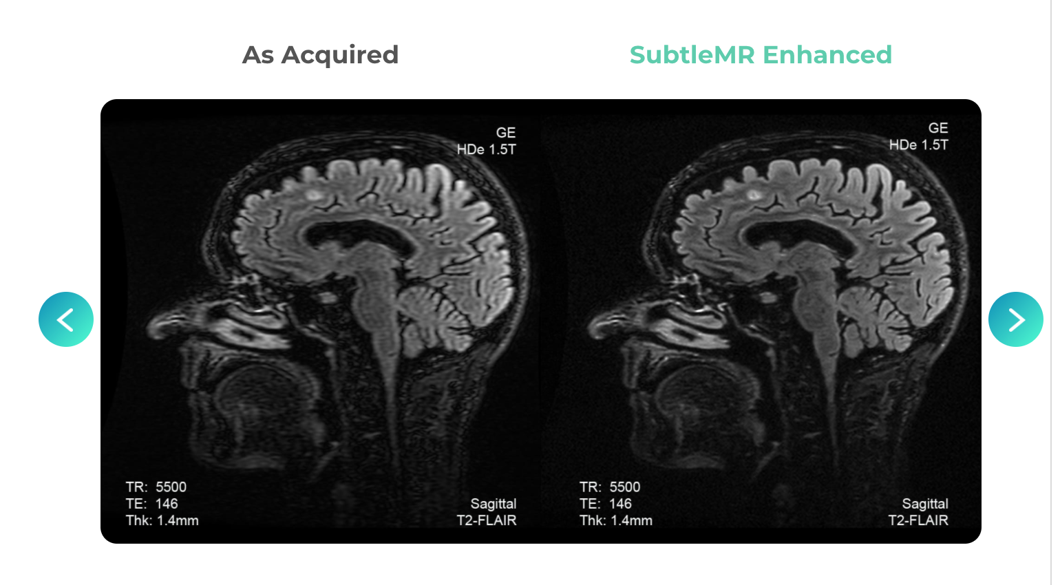 Subtle Medical Expands MR Image Processing Software with SubtleMR 2.0